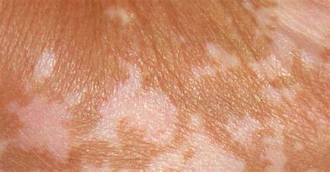 How To Get Rid Of White Patches On Skin Vitiligo Sun Chlorella Work