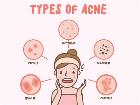 Best Overnight Home Remedies For Acne That Actually Work Be Beautiful