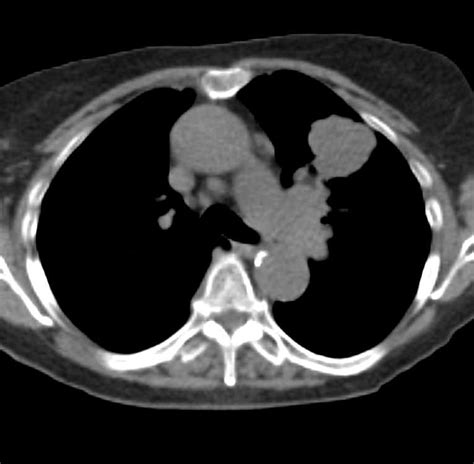 Lung Cancer With Left Hilar Adenopathy Chest Case Studies Ctisus Ct
