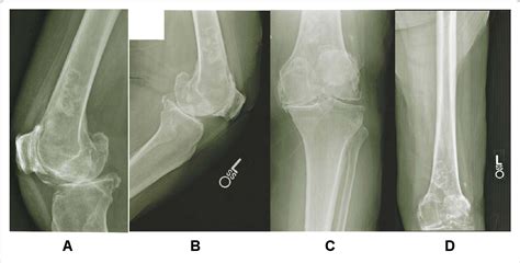 Figure 1 From Treatment Of End Stage Osteoarthritis And Concurrent Bony