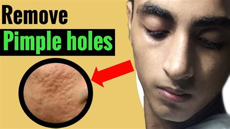 How To Remove Pimple Holes Skin Care Routine To Remove Pimple Holes
