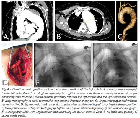 Braz J Cardiovasc Surg Hybrid Treatment Of Aortic Arch Disease