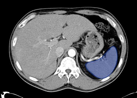 Spleen In Abdomen