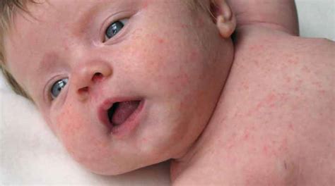 Dermatite atópica em bebês por que ocorre e como tratar Bebê Mamãe