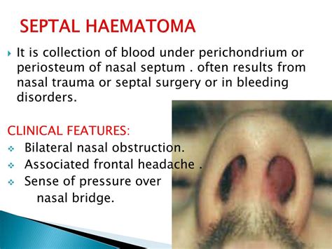 Ppt Nasal Septum And Its Diseases Powerpoint Presentation Free