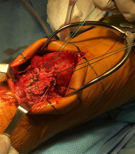Lateral patellar dislocation refers to lateral displacement followed by dislocation of the patella due to disruptive changes to the medial patellar retinaculum. All About Patellar & Quadriceps Tendon Tears | 321GOMD