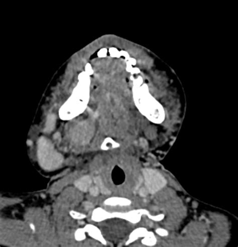 Mixed Venous And Lymphatic Malformations Of The Neck Image