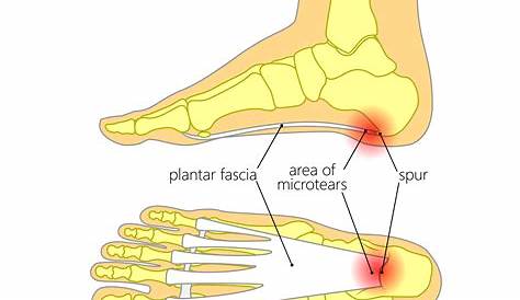 diagram of heel pain