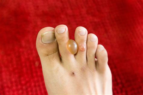 Diabetes And Feet Diabetic Blisters Diagnosis