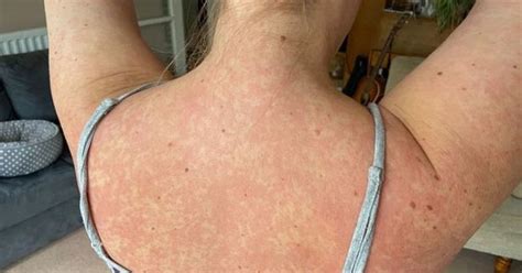 Eight Different Types Of Skin Rashes Could Be A Symptom Of Coronavirus