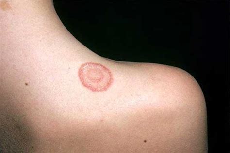 Does Your Child Have Ringworm What You Need To Know Washington Dc