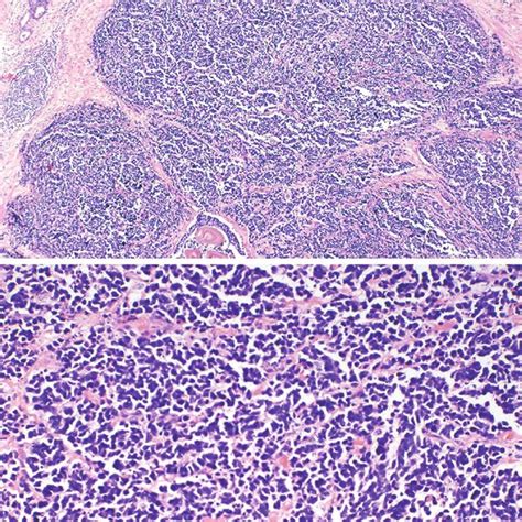 Prostatic Small Cell Carcinoma Hematoxylin And Eosin Stain A