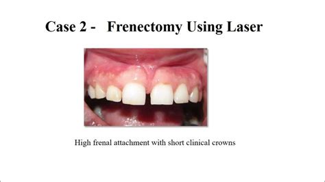 Frenectomy And Frenotomy Surgical Procedures Youtube