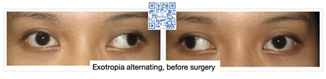 strabismus surgery roque eye clinic ph