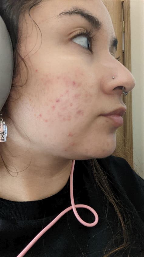 Ive Tried Everything Any Idea What Could Be Causing My Acne Details