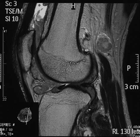 Magnetic Resonance Imaging Of The Knee Demonstrates A Homogeneous