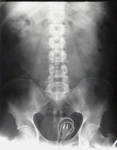 X Rays Of Objects Stuck In Really Strange Places 30 Pics Izismile Com
