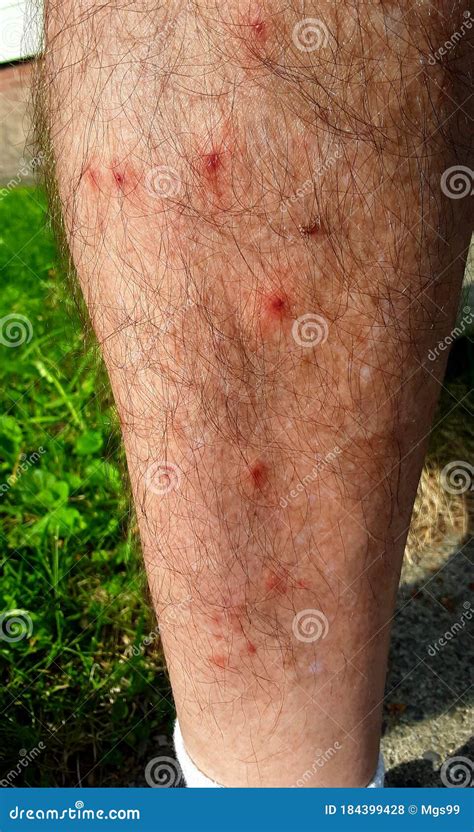 Multiple Nasty Mosquito Bite On Leg Stock Photo Image Of Distrubing