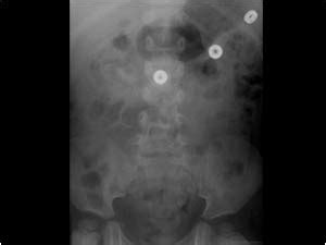 Pediatrics | 9.2 Pediatric urinary tract : Case 9.2.7 Nephrolithiasis