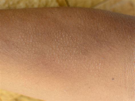 What Is Keratosis Pilaris And What Causes It Balmonds