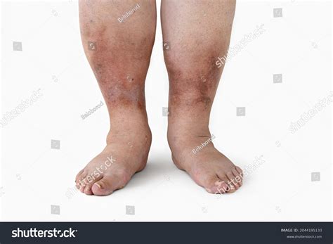 Swelling Leg Inflammation Diabetic Nephropathy Woman Stock Photo