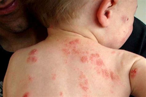 Link Between Eczema And Allergies By Abeapps Medium
