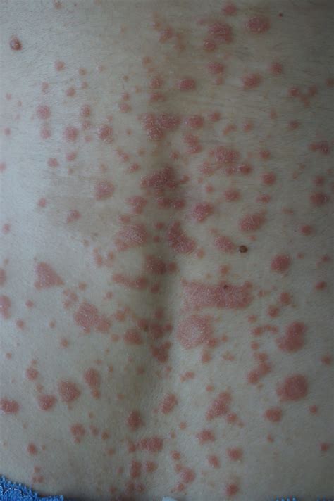 Treatments For Inverse Guttate Pustular And Erythrodermic Psoriasis