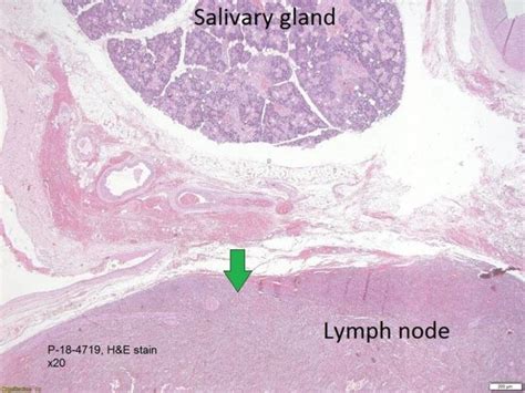 Metastatic Melanoma Infiltrating Into The Lymph Node With Adjacent