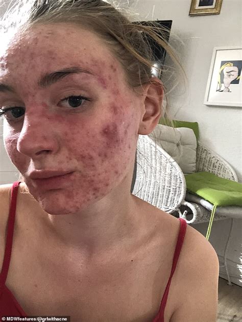 Woman Who Had Cystic Acne So Severe That It Affected Her Sight