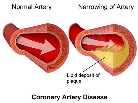 Coronary Artery Disease Simple English Wikipedia The