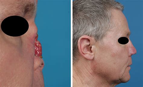 Nasal Reconstruction 1 Dr Gassner
