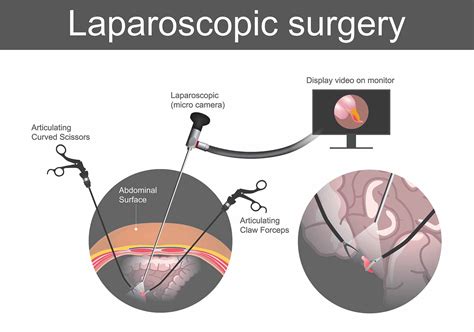 Laparoscopic Hiatal Hernia Repair