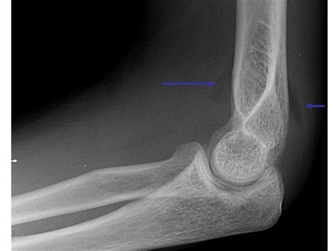 Elbow Case 2 Diagnosis Orthopedic Teaching Feinberg School Of Medicine