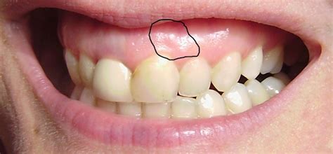 Hard Lump On Lower Gum What Doctors Want You To Know