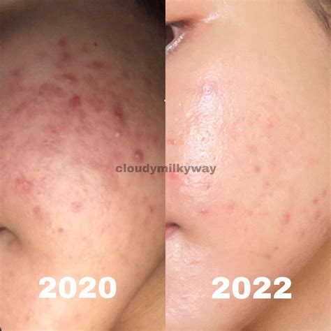 acha 🍭🤍 on Twitter: "hampir 2 tahun berjuang lawan jerawat dan bekas