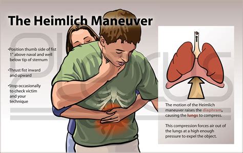 Çocuklarda, yetişkinlerde hatta kendi kendinize uygulayabileceğiniz heimlich manevrası, boğaza takılan yabancı cisim veya yiyecek maddelerinin, elle çıkarılmayacak. Henry Heimlich, médico que creó la famosa maniobra para ...