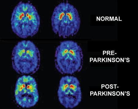 Parkinson's disease is a disorder of the central nervous system (the brain and spinal cord) that affects movement. Parkinson's Disease News: Experiment Reveals Potency of ...