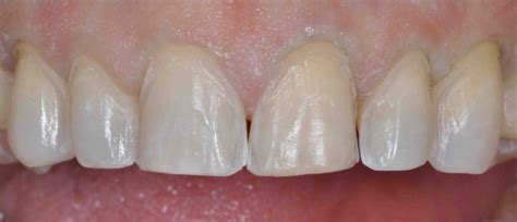 Supragingival Margins When Do They Work Lee Ann Brady Dmd