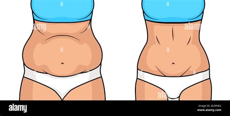 Female Belly Fat Loss Plastic Surgery Abdomen Fatty Girl Abs Lose Before And After Cellulite