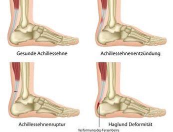 Beim achillessehnenriss (achillessehnenruptur) handelt es sich in der regel um eine plötzlich auftretende durchtrennung der achillessehne. Achillessehnenriss
