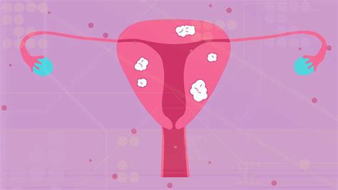 Understanding Racial Disparities For Women With Uterine Fibroids