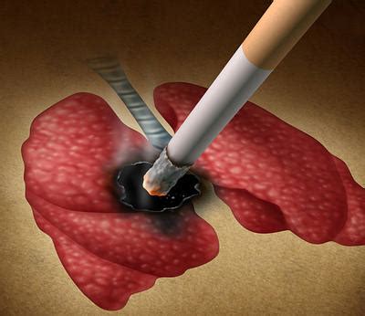 Lung cancer occurs when cells in the lung mutate or change. 10 Reasons Why You Should Quit Smoking Right Now! | Top 10 ...