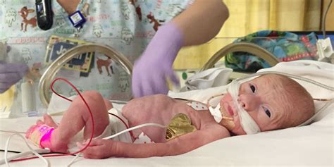 Our Daughter Was Born At 25 Weeks Our Premature Daughters Journey