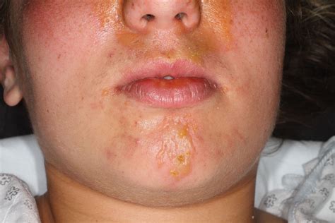 Treat sunburn immediately after it occurs, as this can lead to very serious consequences. How to get rid of sun blisters on face - MISHKANET.COM