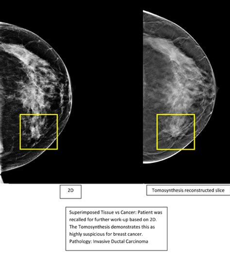 Montclair Breast Center Introduces 3d Mammography