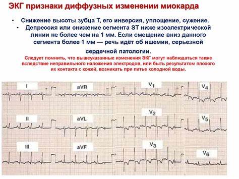 ЭКГ признаки диффузных изменении миокарда - online presentation Картинка - ЭКГ признаки диффузных изменении миокарда - online presentation