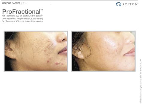 Profractional Laser Tribeca Skin Center Nyc Downtown Manhattan Trusted