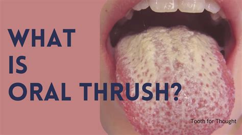 What Is Oral Thrush