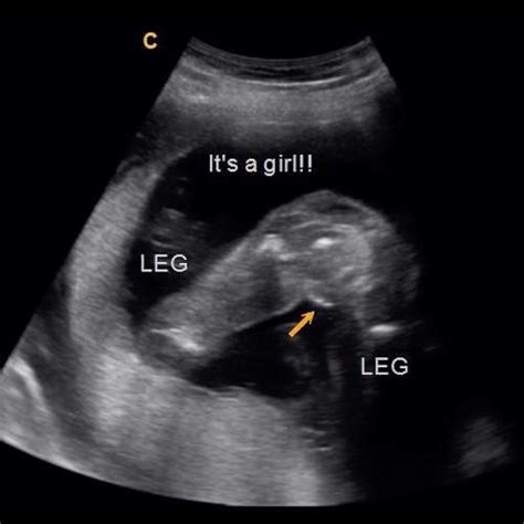 Early Gender Girls 15 Weeks 3d 4d 5d Hd Ultrasound Michigan