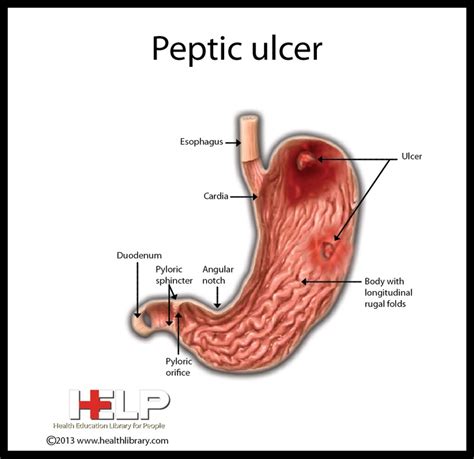 Peptic Ulcer Anatomía